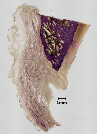 plastic embedded chondrolabral