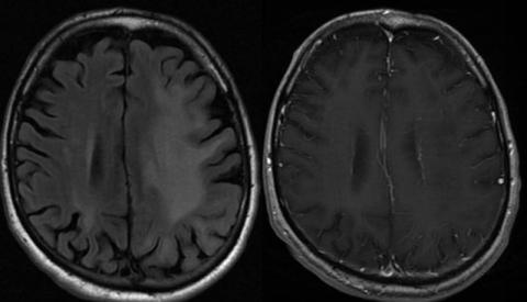 Non-IRIS PML survivor brain