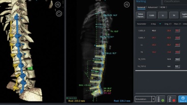 New Robotic Technology Enhances Spine Surgery
